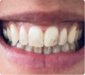 After treatment