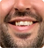Before treatment