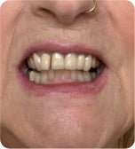 Before treatment