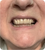 After treatment