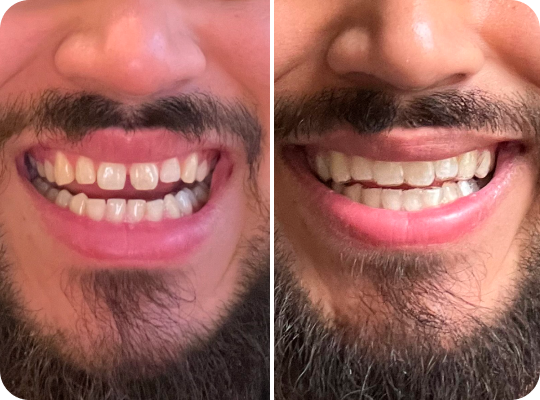 Caspersmile - Spacing