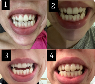 So happy with my new smile!