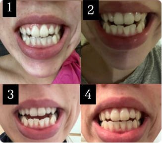 So happy with my new smile!