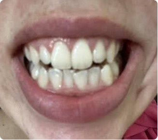 So happy with my new smile!