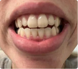 So happy with my new smile!