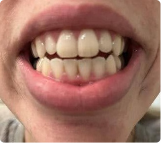 So happy with my new smile!