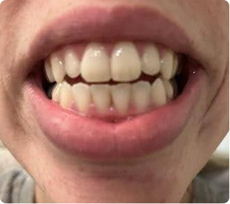 So happy with my new smile!