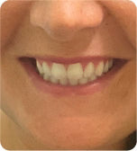 After treatment